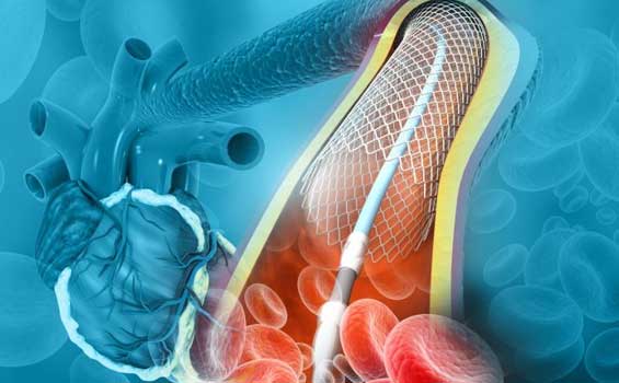 Angioplasty